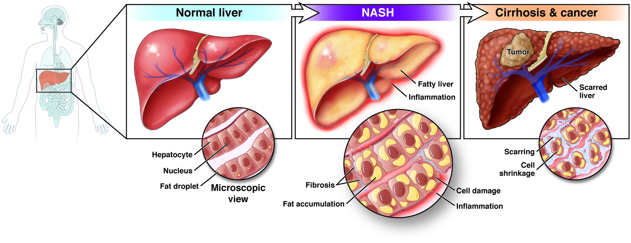 Non alcoholic liver disease