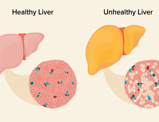 Penyakit Fatty Liver