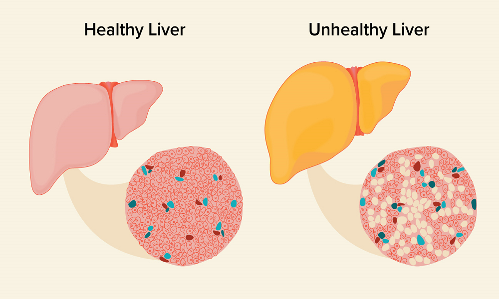 Penyakit Fatty Liver
