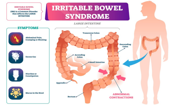 apa-itu-irritable-bowel-syndrome-ibs-gejala-penyebab-pengobatan