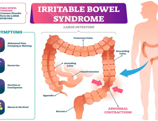 Penyakit Irritable Bowel Syndrome