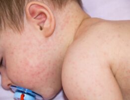 Obat Alergi Kulit Anak