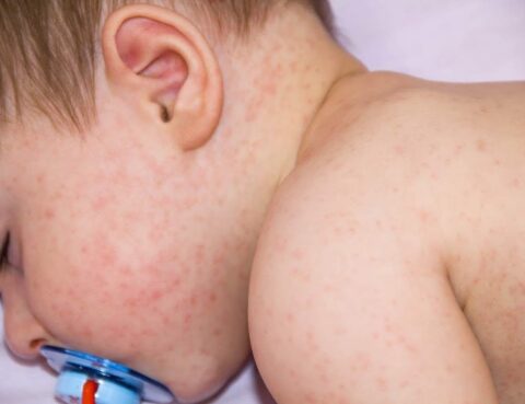 Obat Alergi Kulit Anak